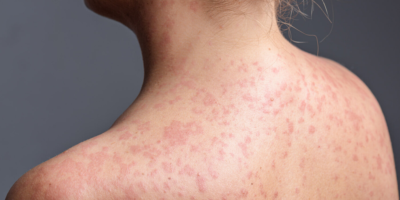 Measels Rose Rash Measles Rash Treatment